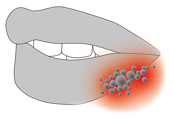 Bild Lippenherpes / © Cumdente